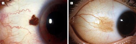 Conjunctival Nevi Dermatology Jama Ophthalmology The Jama Network