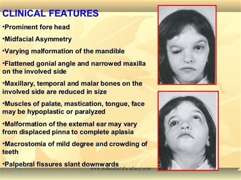 Ssurvivor: Malar Hypoplasia Marfan