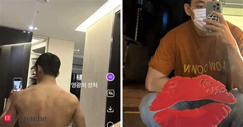 Bts Kim Taehyung Aka V Drops Bareback Photos Shows Off Wound Of