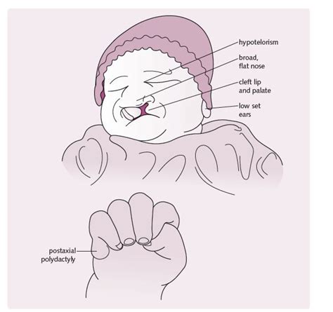 NurseTecmilenio: Genetic Mutations: Patau syndrome