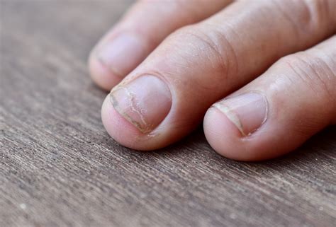 Unästhetische Nagelfalten Warum entstehen sie Kann man sie verhindern