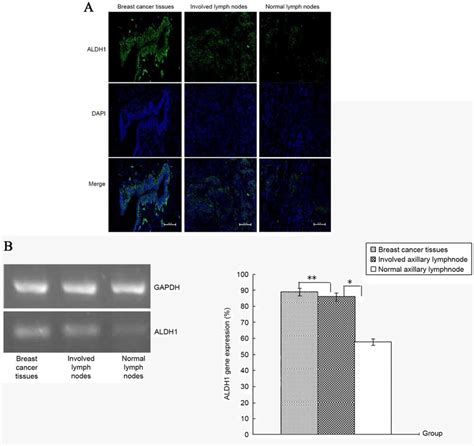 Aldh1 Was Expressed In The Normal Or Involved Aln And Breast Cancer