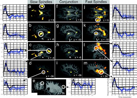 Hemodynamic Cerebral Correlates Of Sleep Spindles During Human Non