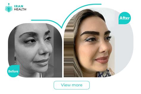 Eyebrow Transplant In Iran Affordable Cost Best Surgeons And Modern