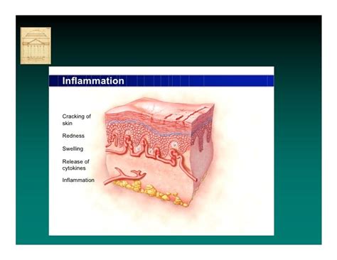 Incontinence Associated Dermatitis By Prof Dr Mikel Gray