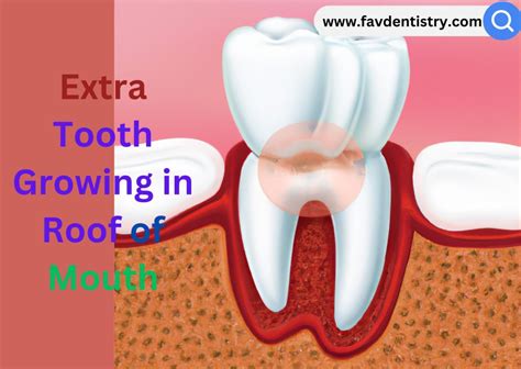 Tooth Growing Out Of Gum Back Of Mouth Causes And Solutions Favourite Dentistry