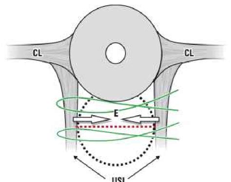 Simple Posterior Fornix Repair A Transverse Incision Is Made In The