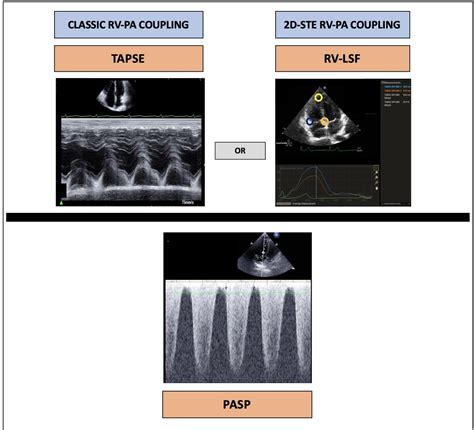 Figure 1 From Prognostic Value Of A New Right Ventricular To Pulmonary