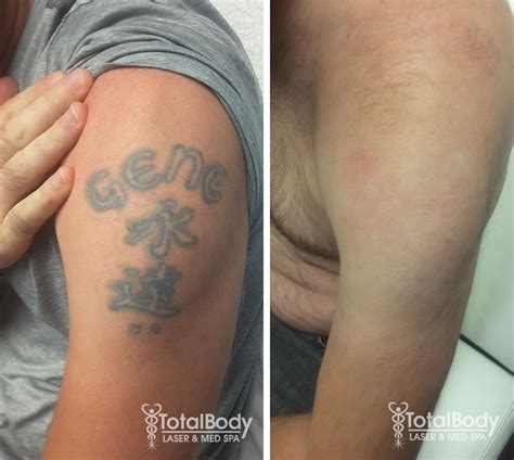 Laser Treatment Before After Photos Total Body Laser Med Spa