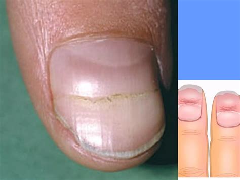 Nail Disorder Dr Aisha Almoosa Ppt