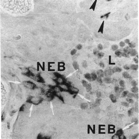 Photomicrographs Of Neuron Specific Enolase Nse 127 129 In The Lung