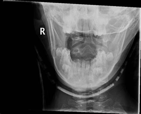 Cervical Spine Subluxation