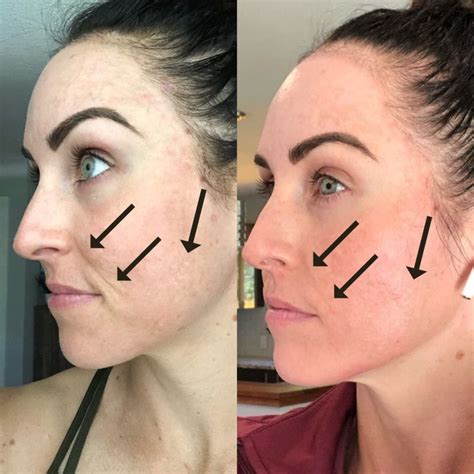 Guide To Microneedling Glowday