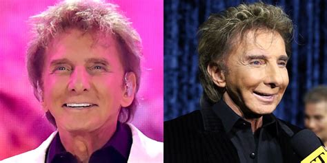 Barry Manilow Before and After - His Plastic Surgery - OtakuKart