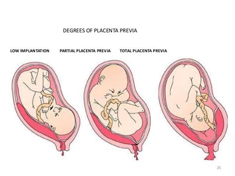 Placenta Previa Diagram