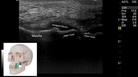 Periapical Abscess Ultrasound Appearance Youtube