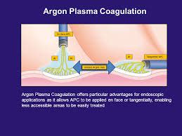 Argon Plasma Coagulation Apc Mediliv Hospital Nashik