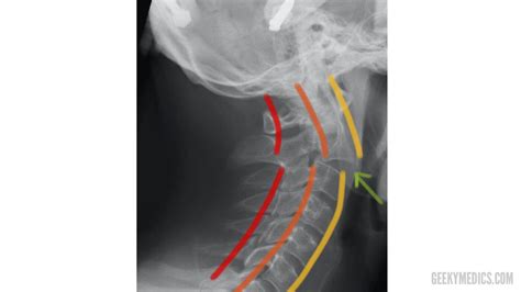 Cervical Spine X Ray Interpretation Osce Guide Geeky Medics