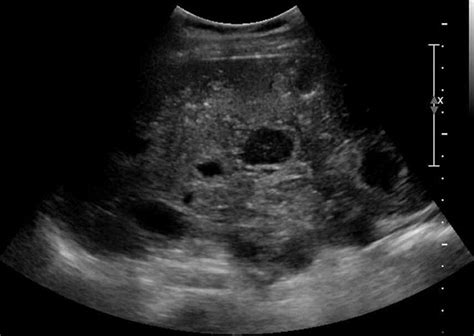 Case 213 Primary Splenic Angiosarcoma Radiology