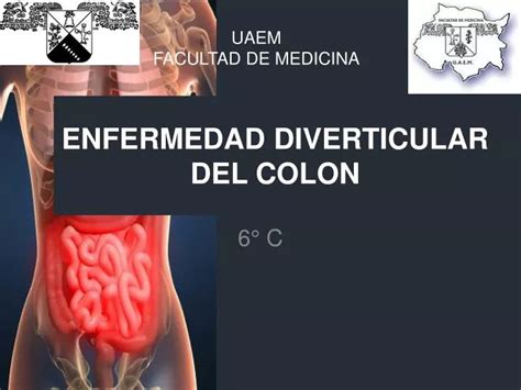 Ppt Enfermedad Diverticular Del Colon Powerpoint Presentation Free Download Id 1045575