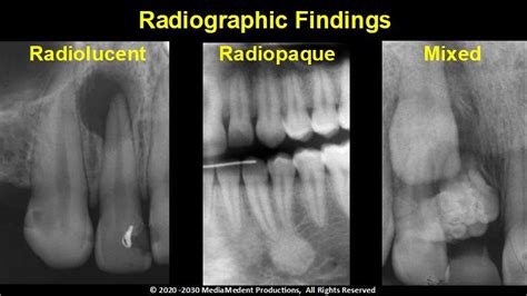 Acclaimed Lectures On Radiolucent Radiopaque Lesions Of The Jaws