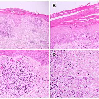 Histopathological Findings Hematoxylin Eosin A Epidermal