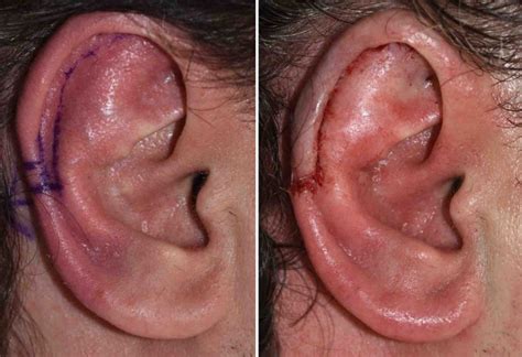 Vertical Ear Reduction With Reverse Otoplasty Result Side View Dr Barry