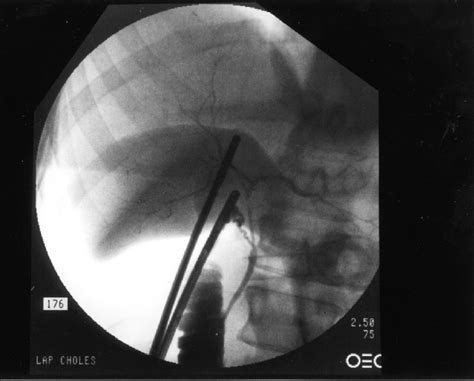 A Typical Cholangiogram Obtained Using The Preview Cholangiogram System