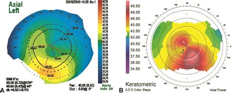 Corneal topography in keratoconus - American Academy of Ophthalmology