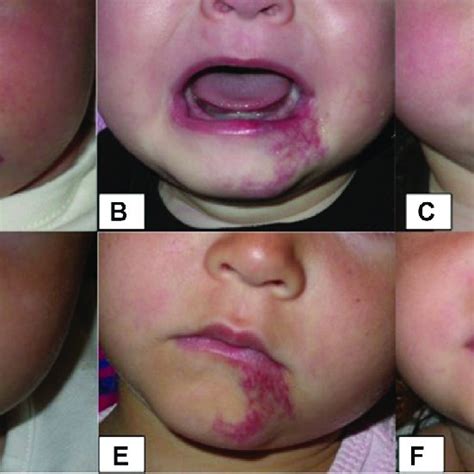 Clinical Example 1 Of Late Infantile Hemangioma Growth A Patient With Download Scientific