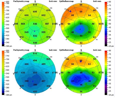 Figure From Clinical Ophthalmology Dovepress Dovepress Oct Corneal