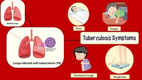 Tuberculosis in Children: Completely Treatable - Dr Ritika Goyal