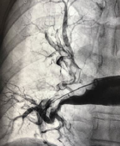 Prise En Charge Endovasculaire De Lembolie Pulmonaire La Phase Aigu