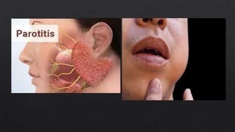 Parotitis Or Mumps Ppt For 3rd Semesters Ppt