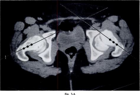 Figure 2 from The association of femoral retroversion with slipped ...