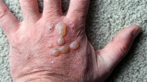 Cluster Of Itchy Blisters On Foot On Sale Emergencydentistry