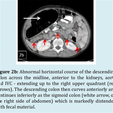 Chronology of normal intestinal rotation: The midgut loop undergoes ...