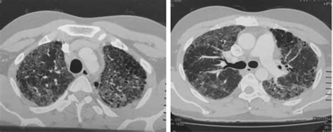 Diffuse Lung Disease Caused By Cotton Dust Exposure Medcrave Online