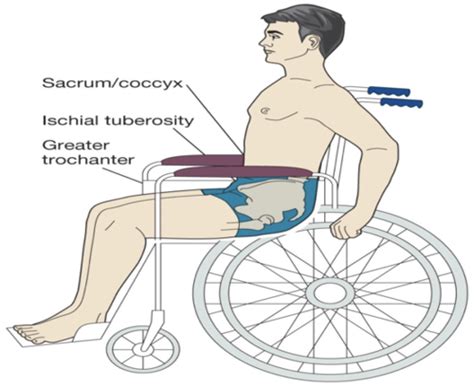 Chapter Pressure Ulcers Ppt Flashcards Quizlet