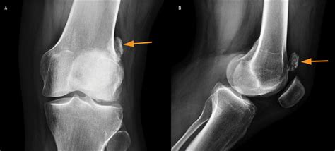 Osseous Fragment In A Patient With Knee Pain Journal Of Orthopaedic