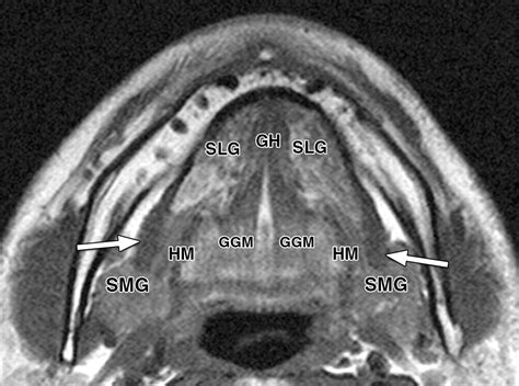 Genioglossus Mri