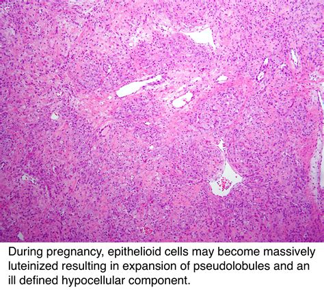 Pathology Outlines Sclerosing Stromal Tumor