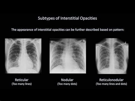 Chest X-ray: Alveolar vs Interstitial Disease | Epomedicine