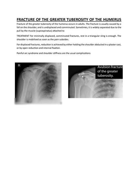 SOLUTION Fracture Of The Surgical Neck Of The Humerus 1 Studypool