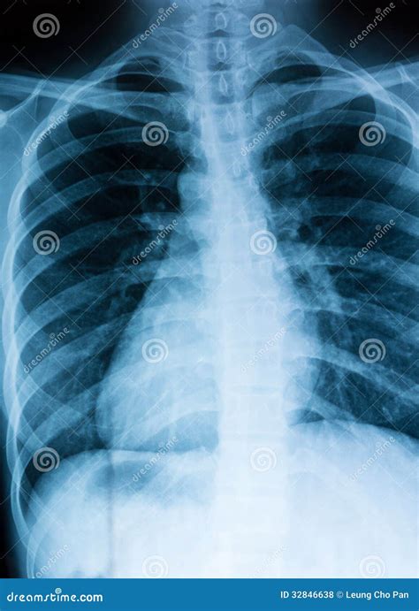 A Chest Xray Of A Patient With Rib Fractures And Pleural Effusion And