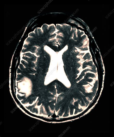 Lymphoma Cancer In The Brain Mri Scan Stock Image M134 0657