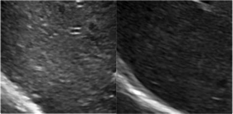 Ultrasound of the liver showing coarse echotexture before dietary ...