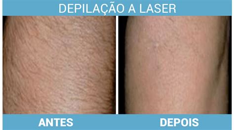 Valores Depila O A Laser Cl Nica De Pele Dr Szerman