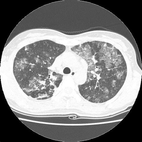 A Chest X Ray Shows Extensive Patchy Areas Of Ground Glass Opacities