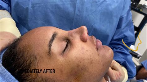 Rhinoplasty For A Wide Nose And Drooping Nasal Tip South Florida